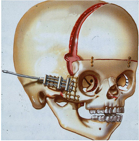 Figur 2. Monobloc osteotomi med intern distraktor.